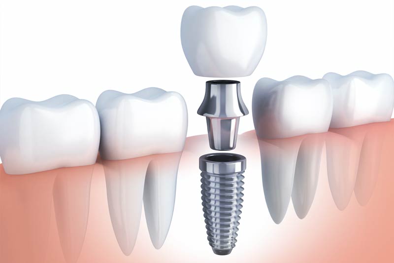 Implants Dentist in Santa Maria